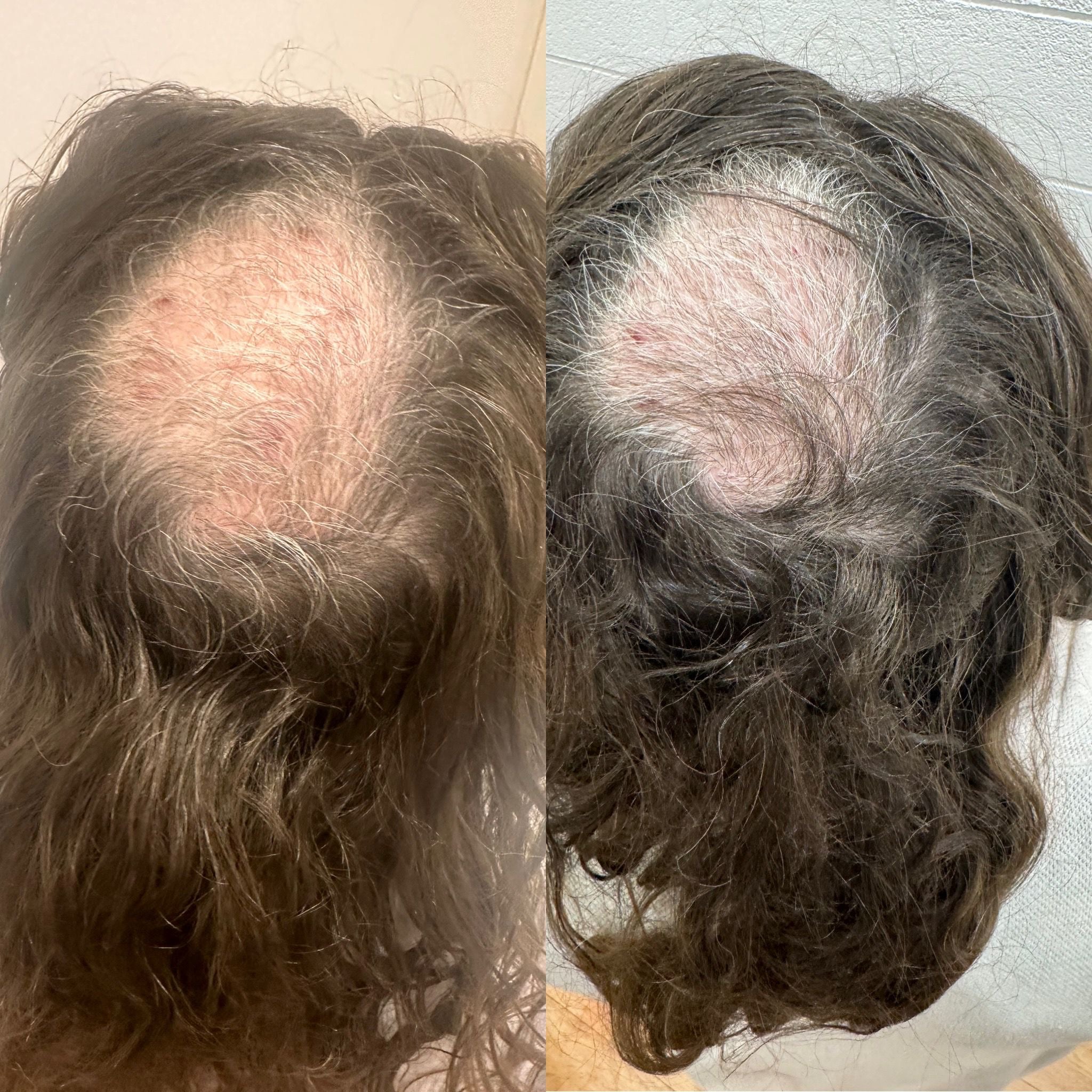 ZOC Hair Growth Oil and Derma Roller