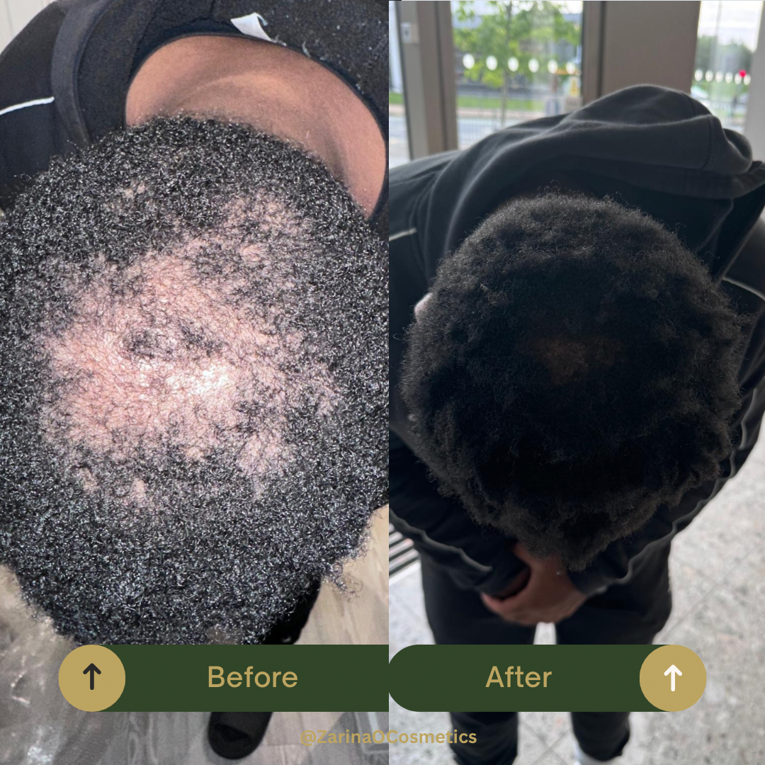 ZOC Hair Growth Oil and Derma Roller